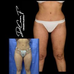 Liposucción - Dr. Federico Coccaro