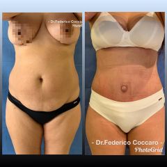 Abdominoplastia - Dr. Federico Coccaro