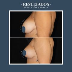 Reducción mamas - Dr. Federico Coccaro