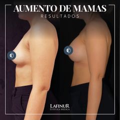 Aumento mamas - Dr. Federico Coccaro