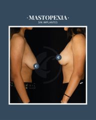 Mastopexia - Dr. Federico Coccaro