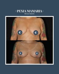 Mastopexia - Dr. Federico Coccaro