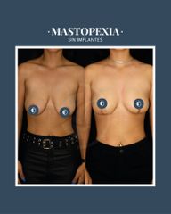 Mastopexia - Dr. Federico Coccaro