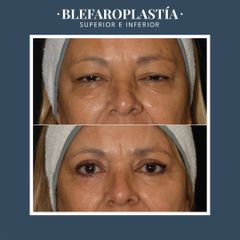 Blefaroplastia - Dr. Federico Coccaro