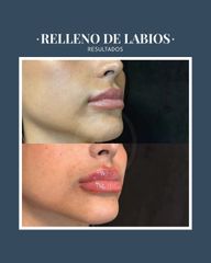 Relleno de labios - Dr. Federico Coccaro