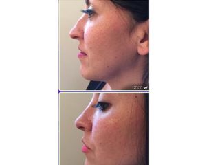 rinoplastia 