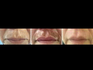 Arrugas peribucales con PLASMA LÁSER
