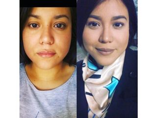 Afinamiento facial enzimatico sin cirugía