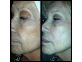 Hifu facial