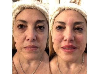 Rellenos con fillers de plasma rico
