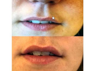Relleno de labios