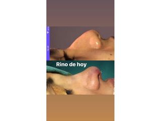 Rinoplastía