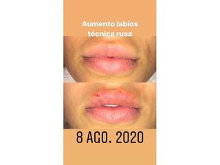 Aumento de Labios