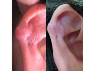 Tratamiento de Queloides