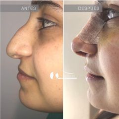 Rinoplastia - Dr. Diego Cunille