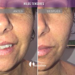 Hilos tensores - Dr. Diego Cunille