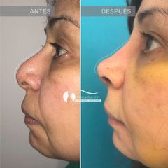 Rinoplastia - Dr. Diego Cunille