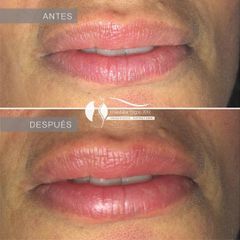 Relleno de labios - Dr. Diego Cunille