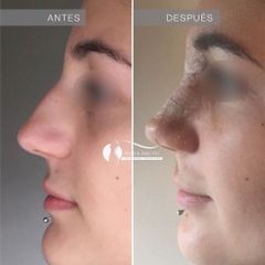 Rinoplastia - Dr. Diego Cunille