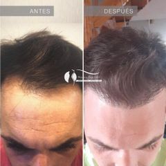 Implante Capilar - Dr. Diego Cunille