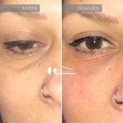 Rellenos faciales - Dr. Diego Cunille