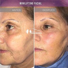 Lifting - Dr. Diego Cunille