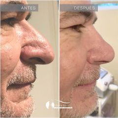 Rinoplastia - Dr. Diego Cunille