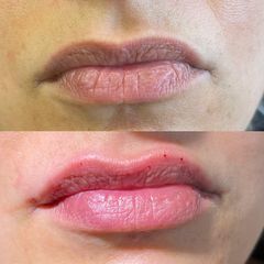 Relleno de labios - Dr. Diego Cunille