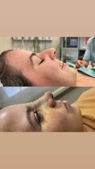 Rinoplastia - Dr. Diego Cunille