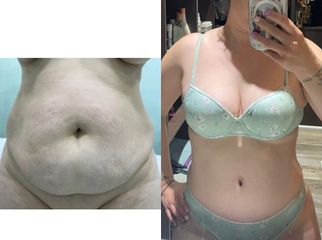 Abdominoplastia - Dr. Diego Cunille