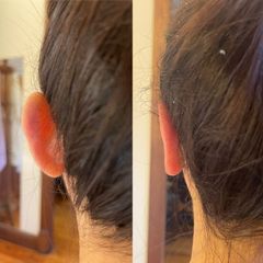 Otoplastia - Dr. Diego Cunille