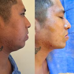 Endolift - Dr. Diego Cunille