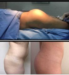 Gluteoplastia con protesis intramuscular - Dr. Matias Llabres
