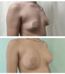 Mastopexia (Simetrización Mamaria con areoloplstia) - Dr. Matías Llabres