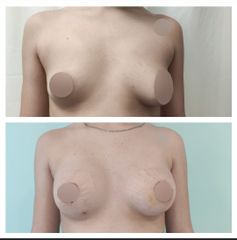 Mastopexia (Simetrización Mamaria con areoloplstia) - Dr. Matías Llabres