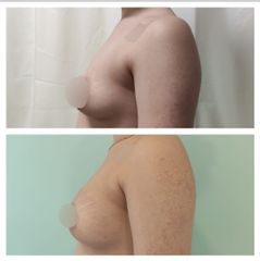 Mastopexia (Simetrización Mamaria con areoloplstia) - Dr. Matías Llabres