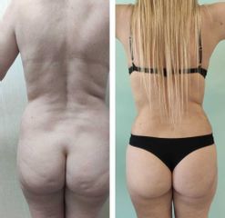 Lipoescultura - Dr. Matías Llabres