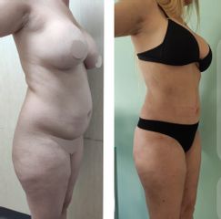 Lipoescultura - Dr. Matías Llabres