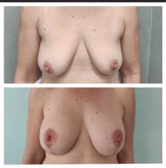 Mastopexia - Dr. Matías Llabres