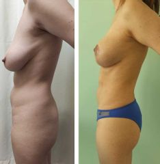Mastopexia - Dr. Matías Llabres