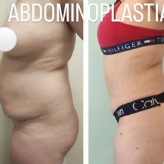 Abdominoplastia - Dr. Matías Llabres