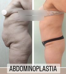 Abdominoplastia - Dr. Matías Llabres