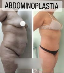 Abdominoplastia - Dr. Matías Llabres