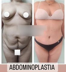 Abdominoplastia - Dr. Matías Llabres