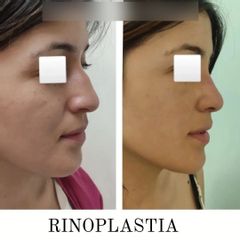 Rinoplastia - Dr. Matías Llabres