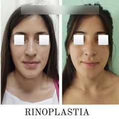 Rinoplastia - Dr. Matías Llabres
