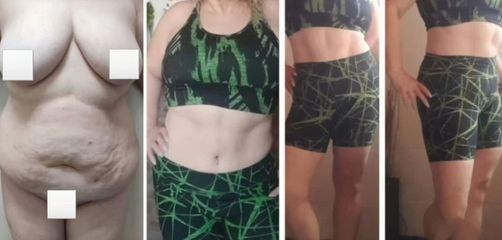 Abdominoplastia - Dr. Matías Llabres