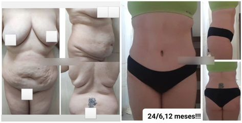 Abdominoplastia - Dr. Matías Llabres