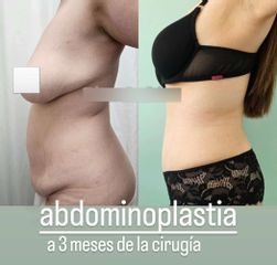 Abdominoplastia - Dr. Matías Llabres