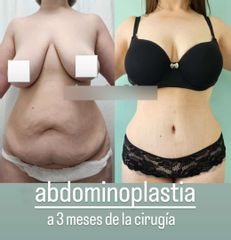 Abdominoplastia - Dr. Matías Llabres